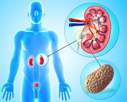 Illustration for article titled Obat Alami Untuk Penyakit Kencing Batu